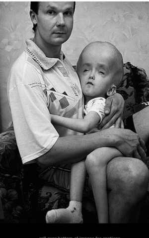 vittima del disastro nucleare di Chernobyl