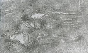 Istria, Foiba di Terli, corpi estratti (Albina, Fosca, Caterina Radecchi, Amalia Ardossi)